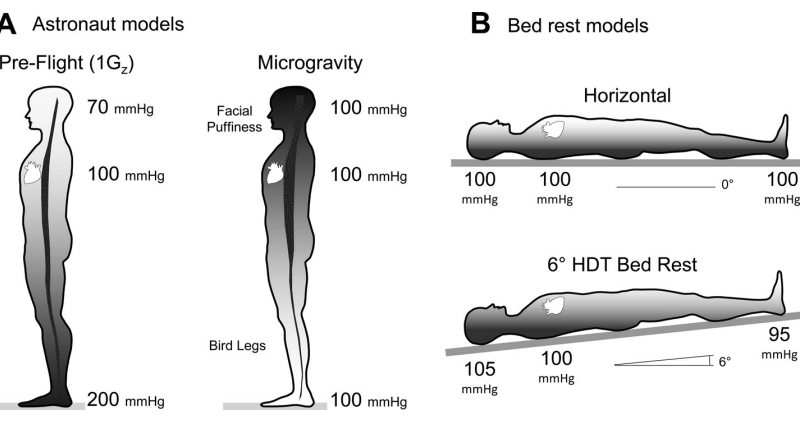 This figure shows how HDT bed rest is used as an analogue for astronauts during long-duration microgravity flight. Credit: Hargens AR et al. 2016.