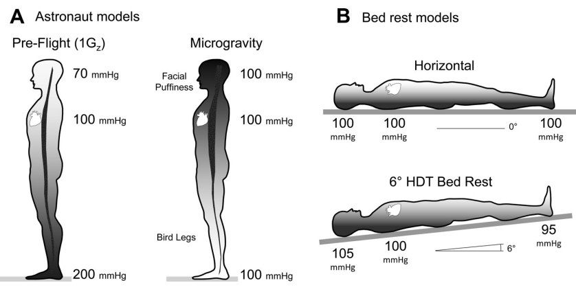 This figure shows how HDT bed rest is used as an analogue for astronauts during long-duration microgravity flight. Credit: Hargens AR et al. 2016.